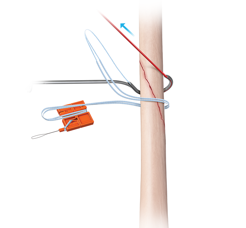 Arthrex - QuickPass FiberTape Cerclage System (for Humerus